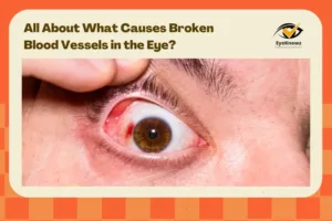 All About What Causes Broken Blood Vessels in the Eye?