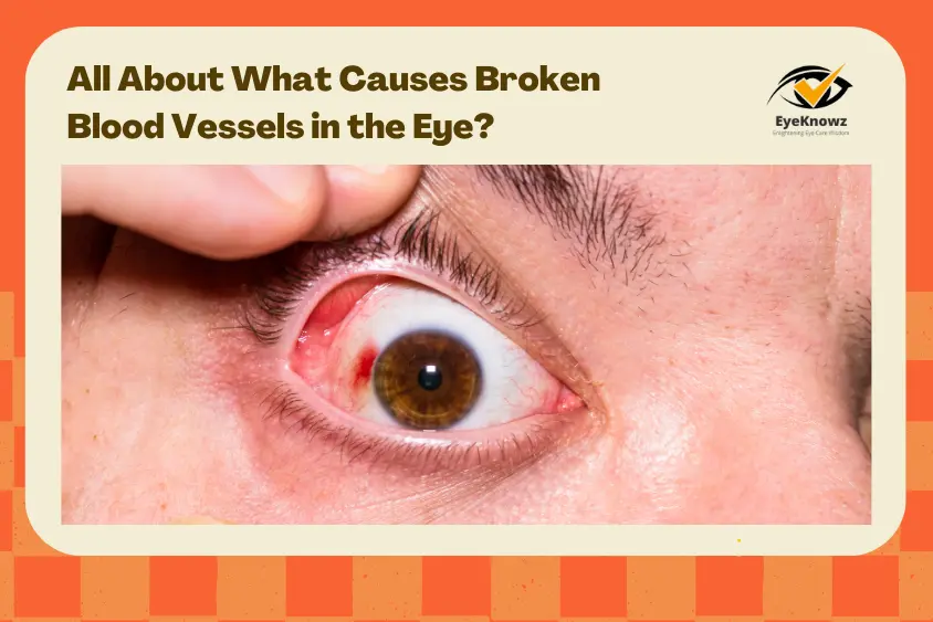 All About What Causes Broken Blood Vessels in the Eye