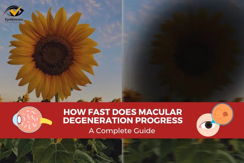 How Fast Does Macular Degeneration Progress A Complete Guide