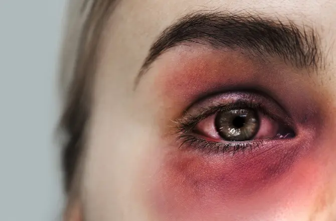 Symptoms of Subconjunctival Haemorrhage