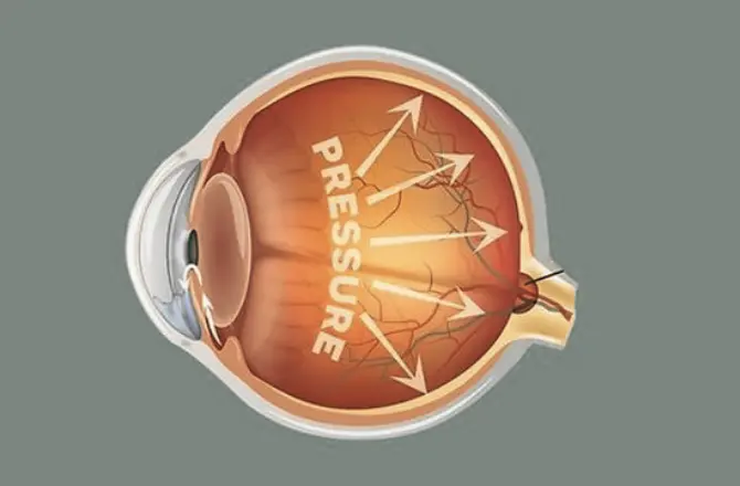 What is Intraocular Pressure (IOP)