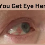 Can You Get Eye Herpes