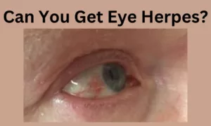 Can You Get Eye Herpes