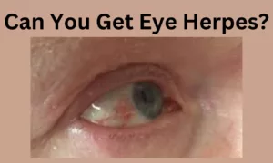 Can You Get Eye Herpes? | Is It Possible?