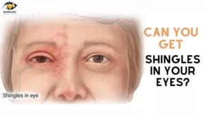 Can You Get Shingles In Your Eye? | A Question Worth Asking