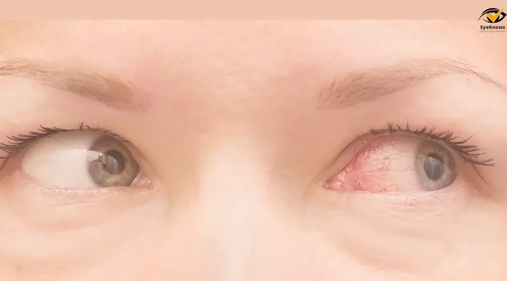 Conjunctivitis