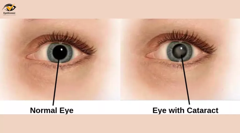 Connection Between Diabetes And Cataracts