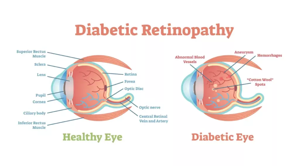 Diabetic and vision