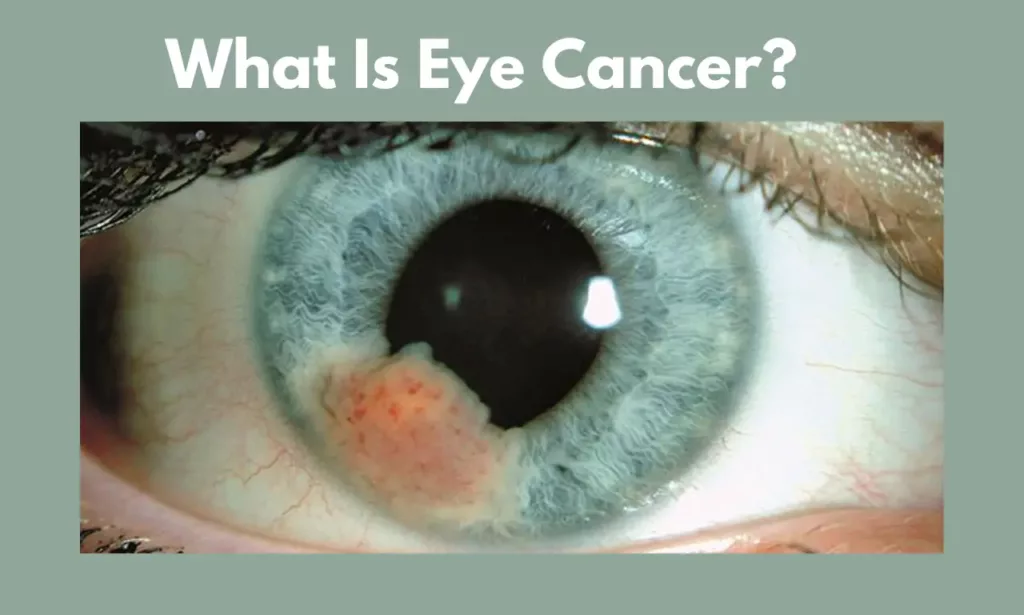 eye cancer