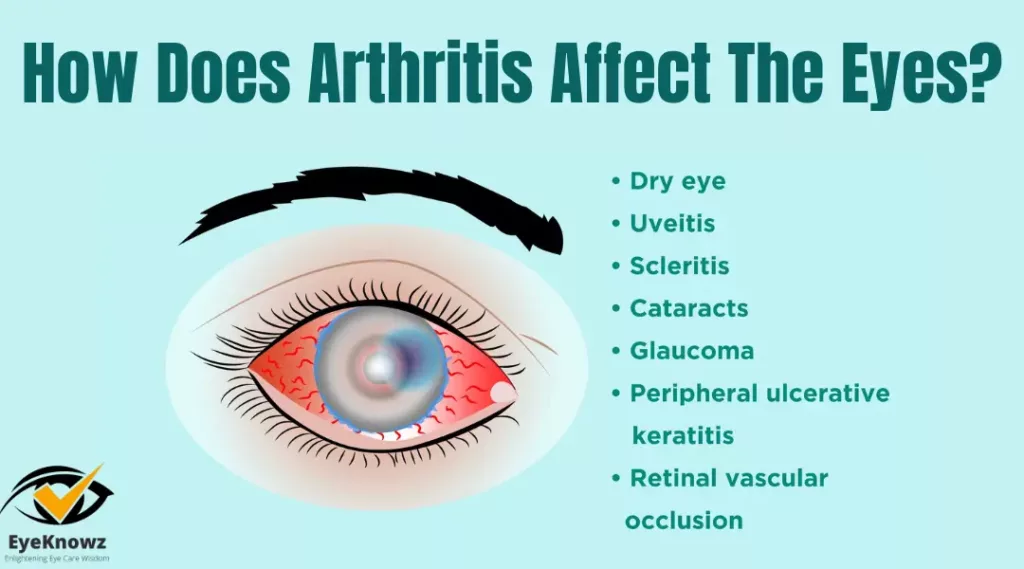 How Does Arthritis Affect The Eyes