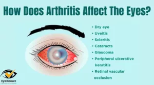 How Does Arthritis Affect The Eyes?