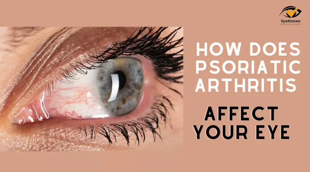 How Does Psoriatic Arthritis Affect The Eyes