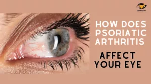 How Does Psoriatic Arthritis Affect The Eyes?