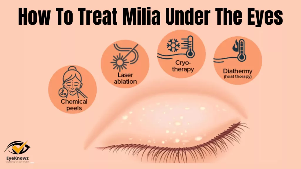 How To Treat Milia Under The Eyes 1