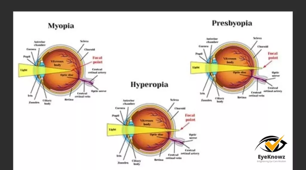 Myopia Vs Hyperopia Vs Presbyopia