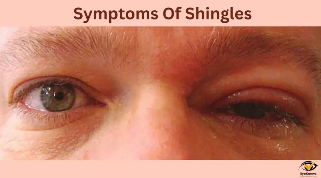 Symptoms Of Shingles