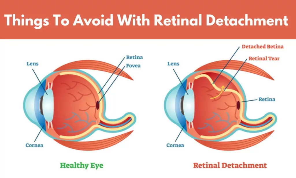 Things To Avoid With Retinal Detachment