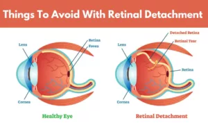 Things To Avoid With Retinal Detachment | Crucial Precautions