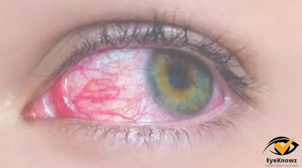 What Causes Pink Eye in Kids