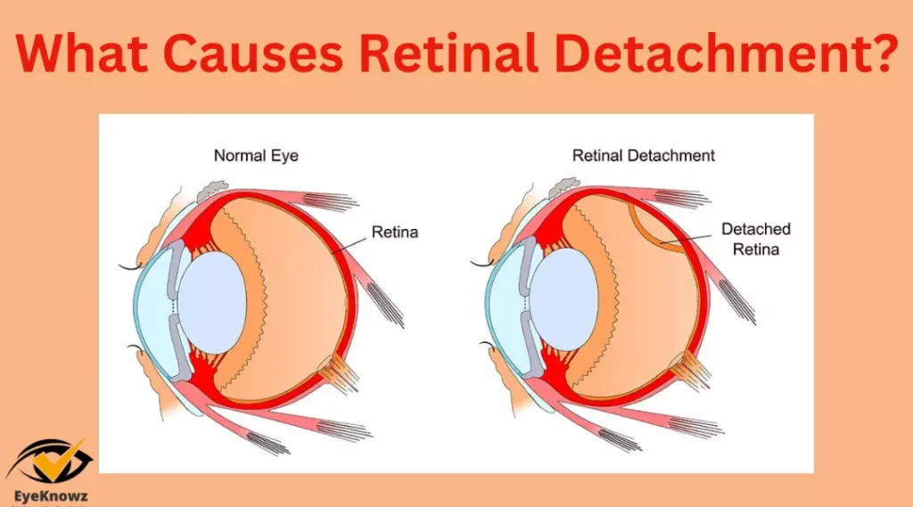 What Causes Retinal Detachment 1 1