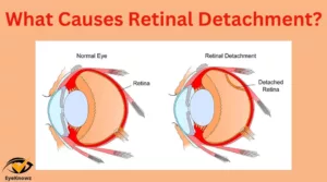 What causes retinal detachment? Everything that you should know!