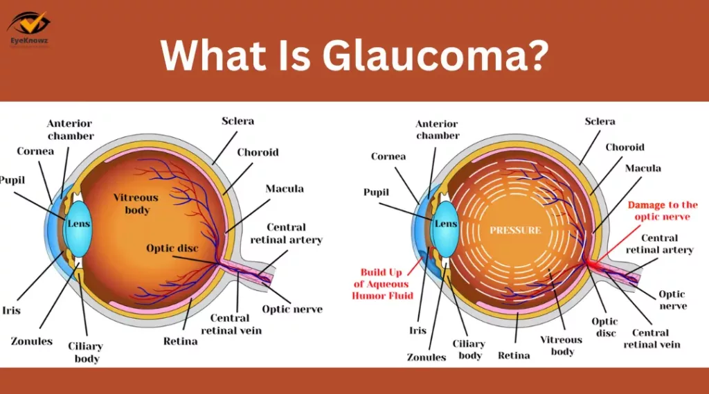 What Is Glaucoma