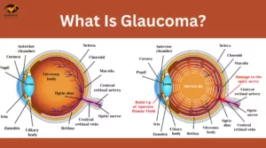 What Is Glaucoma? | The Comprehensive Guide for All