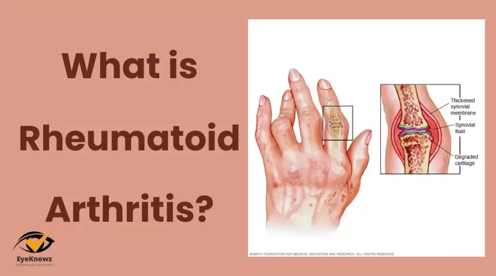 What is Rheumatoid Arthritis 1 1