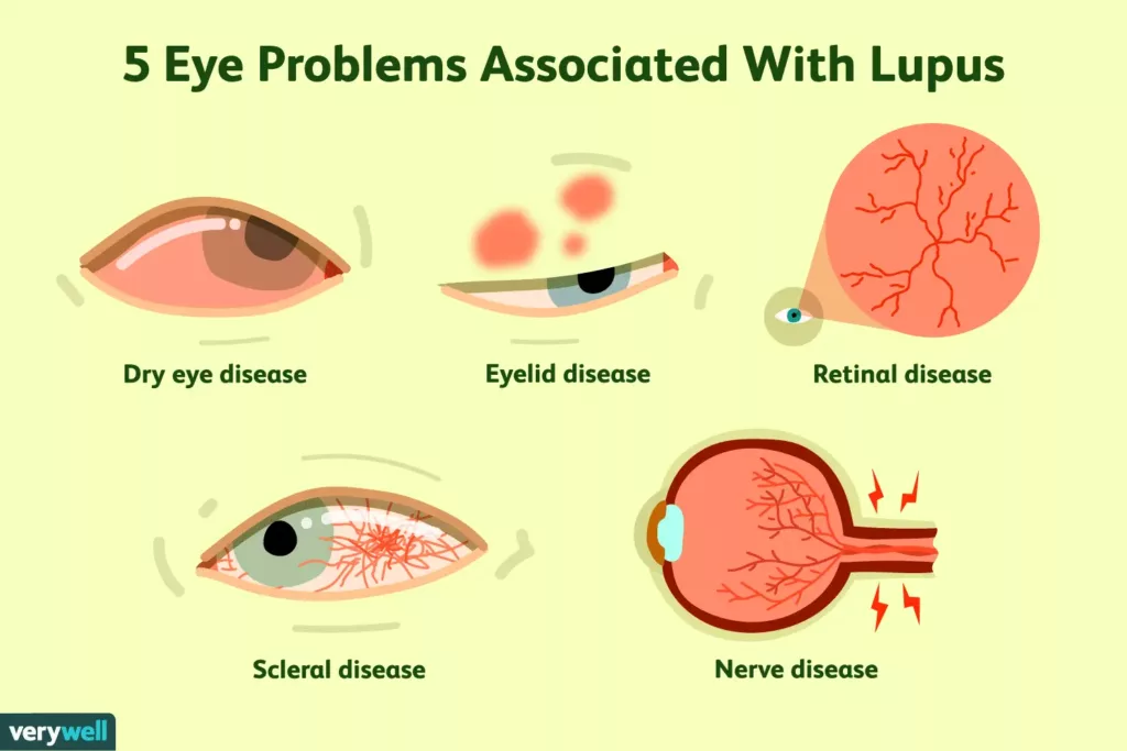 lupus and the eyes