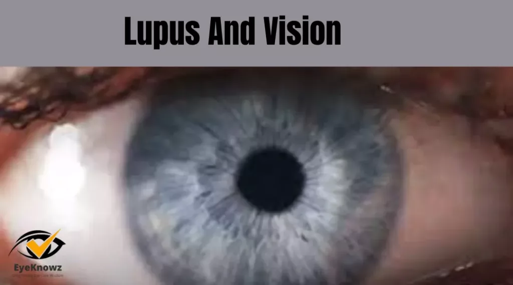 lupus and vision problems