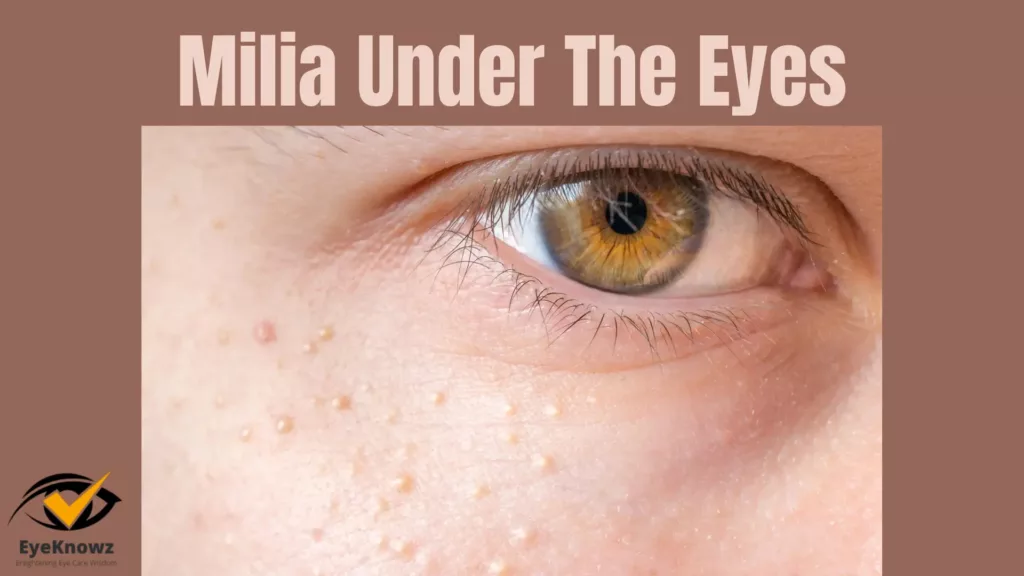 milia under the eyes