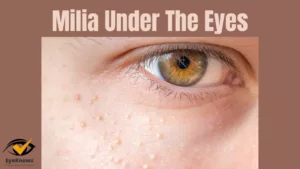 What to know about milia under the eyes?