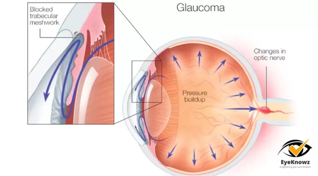 open angle glaucoma