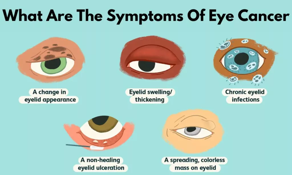 what are the symptoms of eye cancer